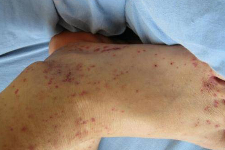 脚背毛细血管网明显有紫色血