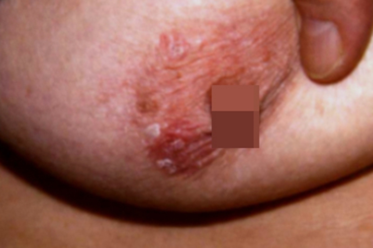 乳房Paget病疙瘩图