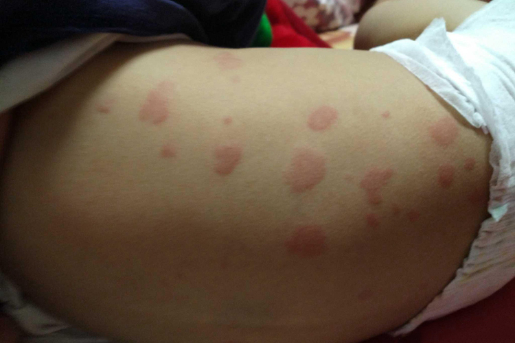 鳕鱼过敏背部红斑图