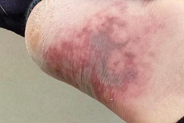 冻疮脚踝症状图 冻疮脚踝症状图