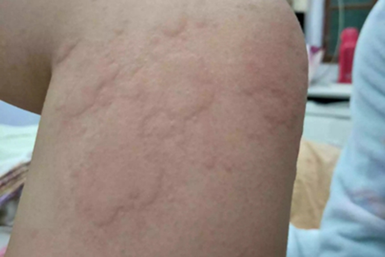 皮肤过敏红肿大腿疙瘩图