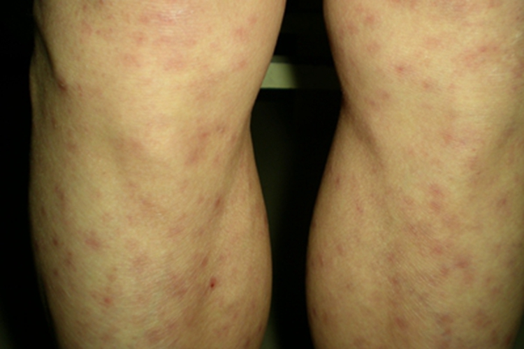 斑疹性梅毒疹腿部症状图 斑疹性梅毒疹腿部症状图