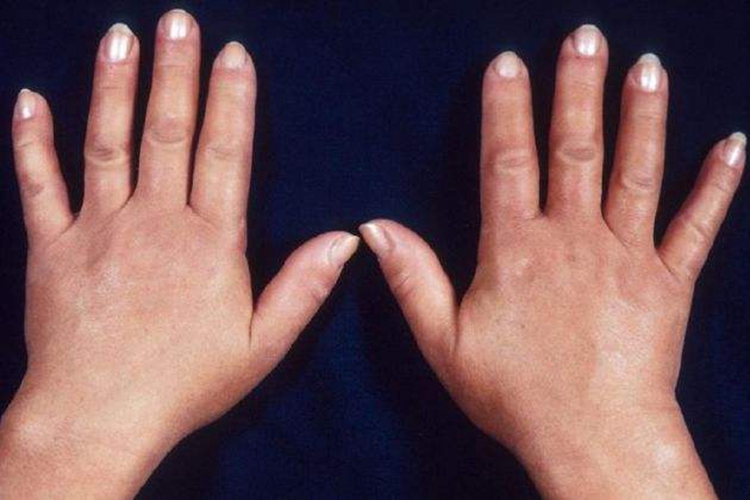 系统性硬化症皮肤肿胀期图