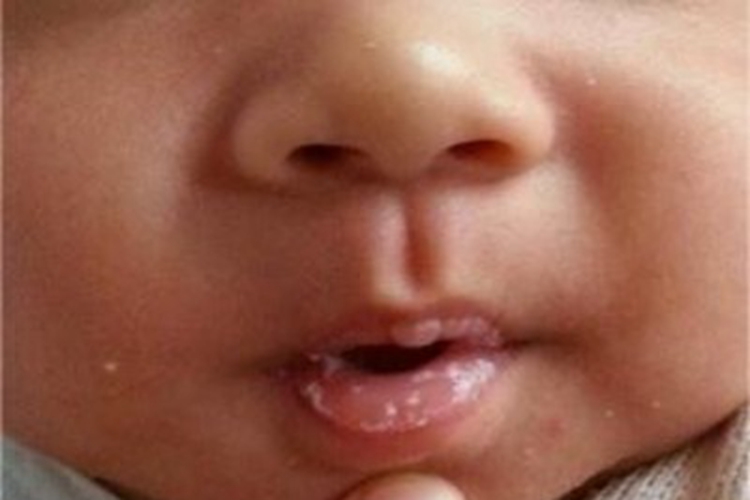 鹅口疮嘴唇症状图 鹅口疮嘴唇症状图