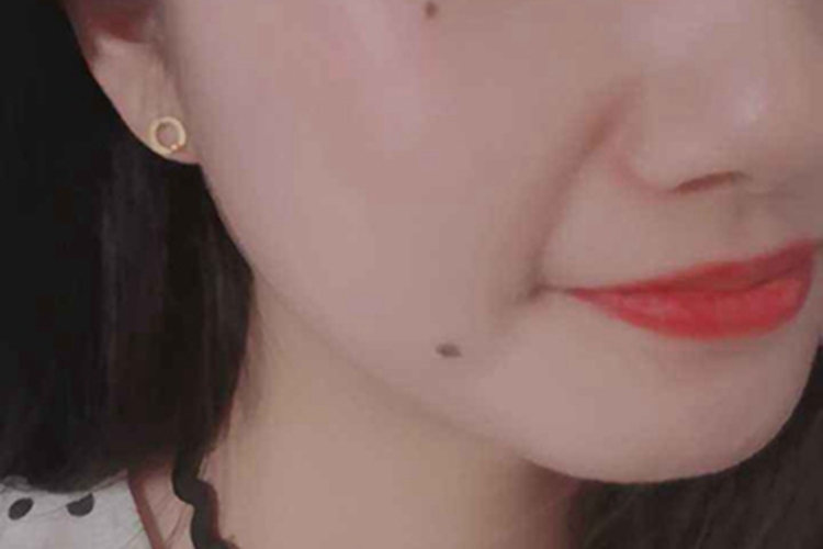 交界痣脸上有两个黑痣图 交界痣脸上有两个黑痣图