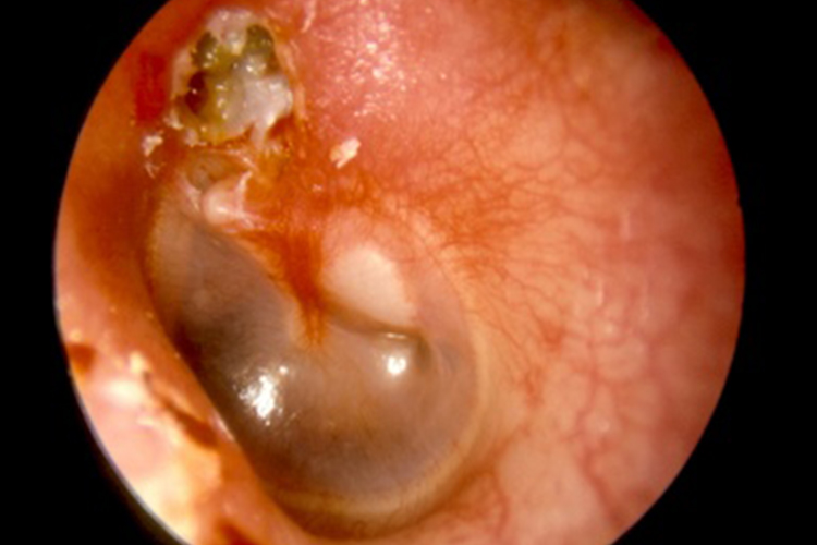 耳镜下中耳胆脂瘤图