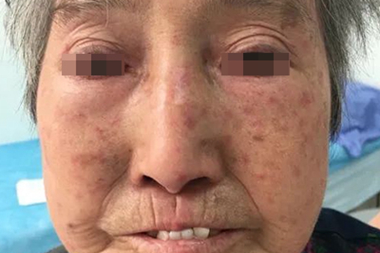 系统性硬皮病面部僵硬图 系统性硬皮病面部僵硬图