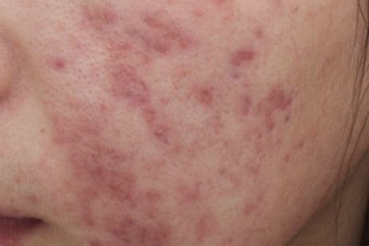 炎症后色素沉着红斑图