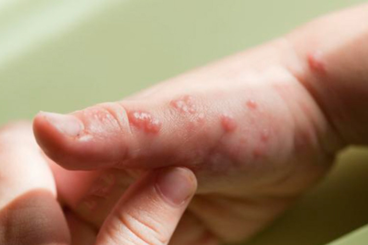 手指头汗疱疹图