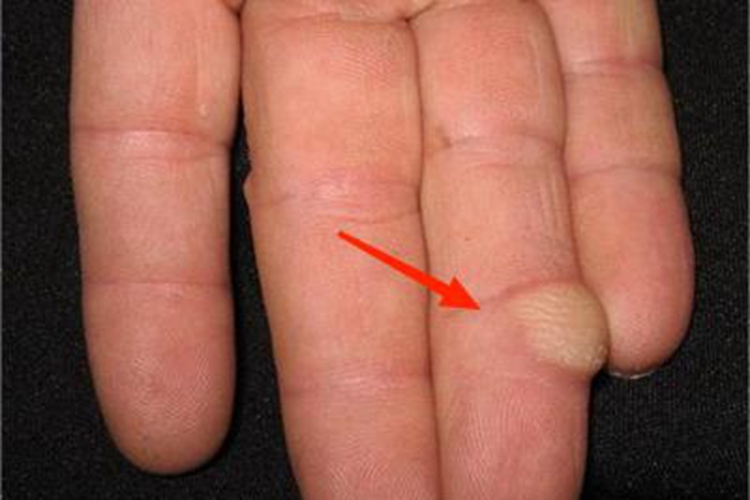 腱鞘巨细胞瘤硬疙瘩图