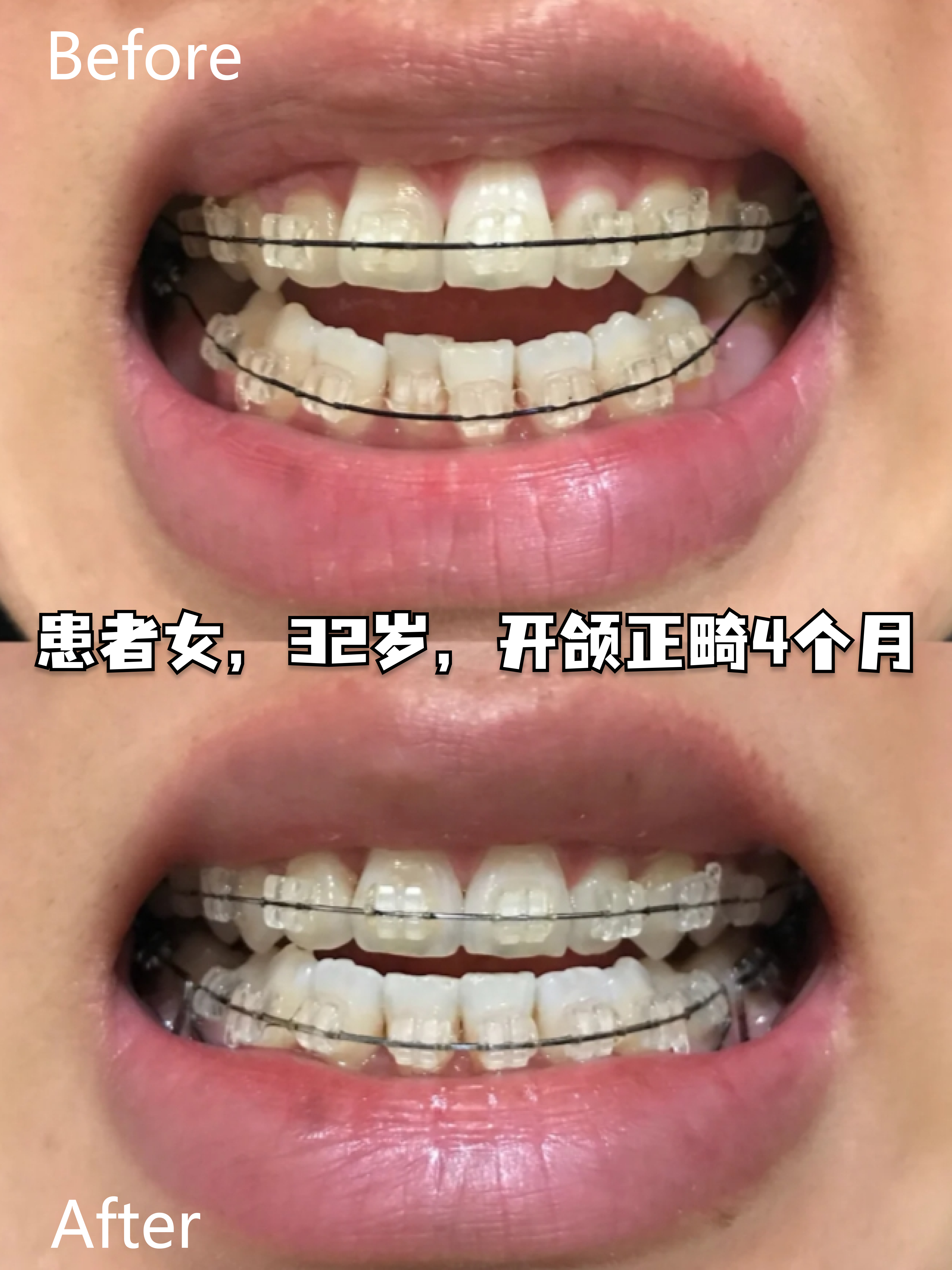 困扰无数人的牙齿开颌,要怎么矫正?