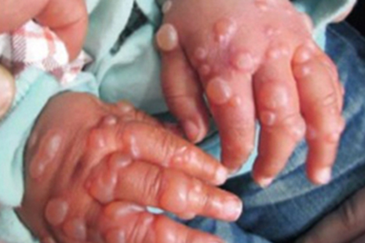 大疱性表皮松解症手部水疱图