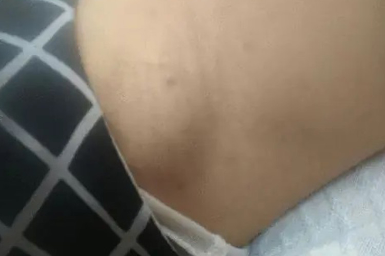 艾滋病初期腋窝淋巴结肿大图