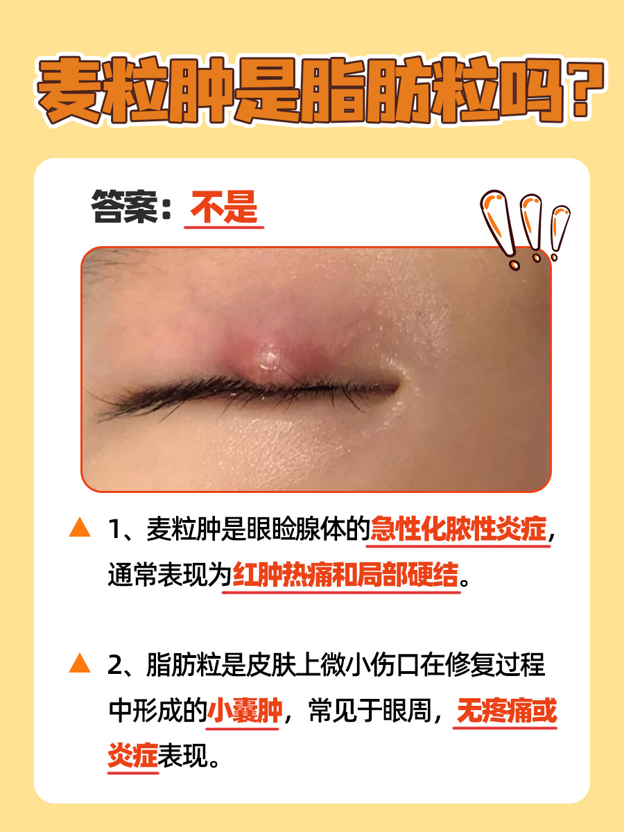 误区揭秘:麦粒肿并非脂肪粒!一文教你分清!