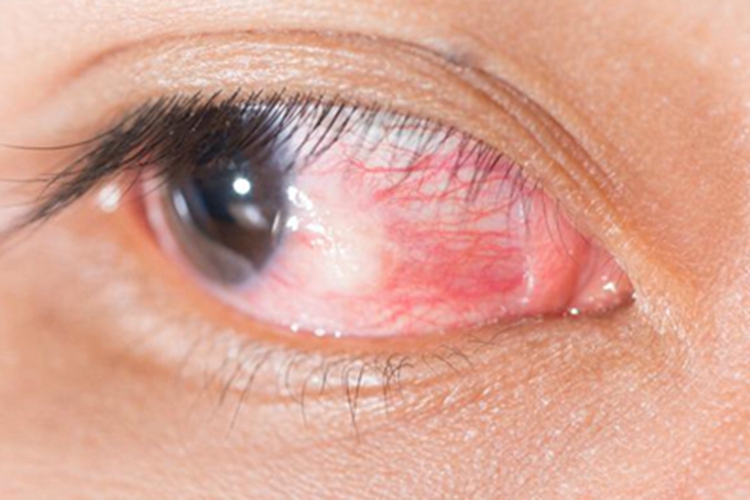 单纯性表层巩膜炎眼睛有血丝图 单纯性表层巩膜炎眼睛有血丝图