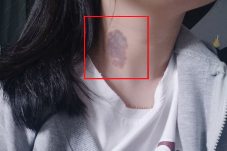 色素型胎记颈部斑图