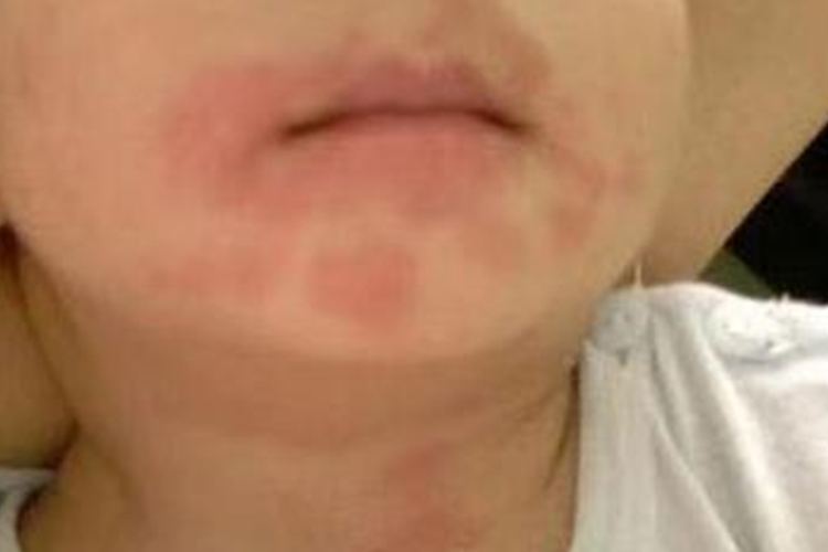 吃小龙虾过敏面部红肿图 吃小龙虾过敏面部红肿图