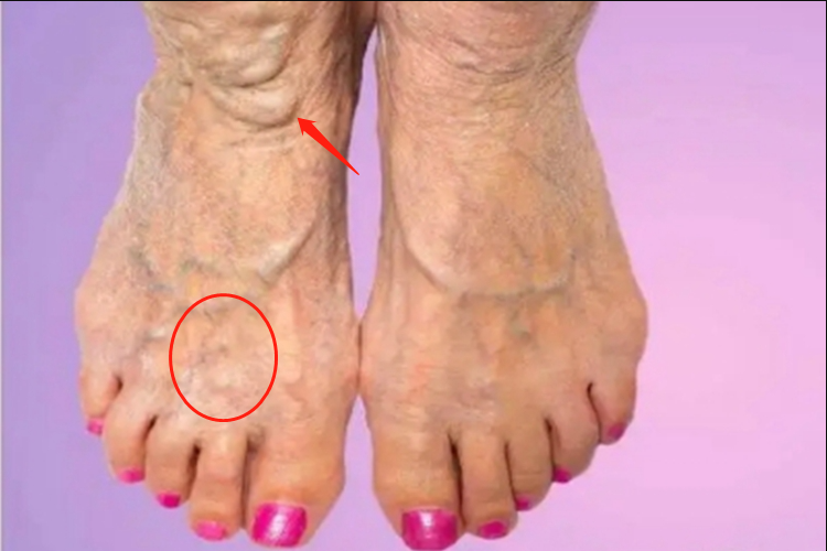 浅表性皮肤脂肪瘤痣脚部疙瘩图 浅表性皮肤脂肪瘤痣脚部疙瘩图