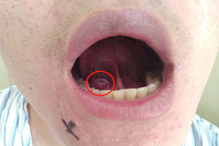 单纯型舌下腺囊肿图