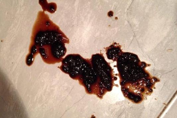 结肠炎黏液血便图 结肠炎黏液血便图