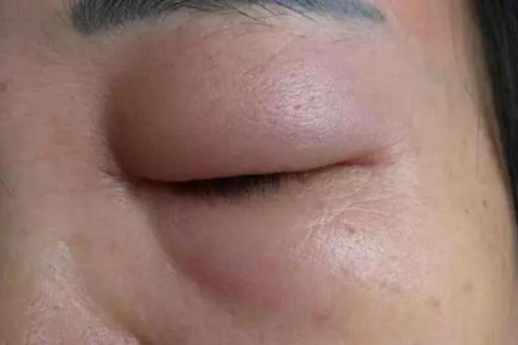 百香果过敏颜面部水肿图