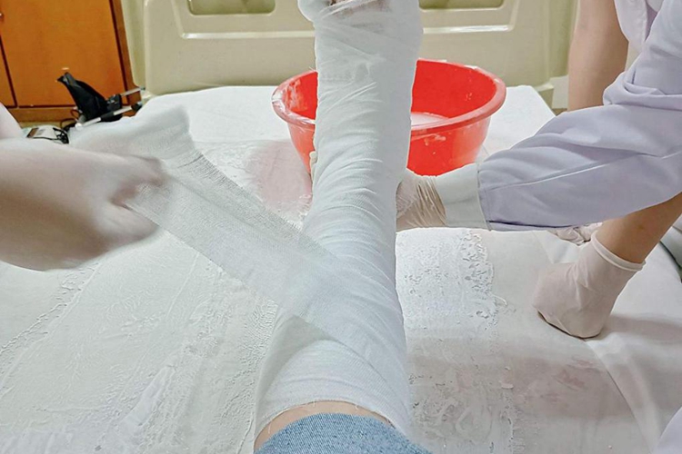 脚骨折打石膏图