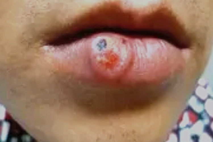 梅毒性唇下疳长肿块图