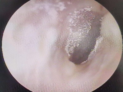 霉菌性外耳道炎耳朵里面有小碎屑图