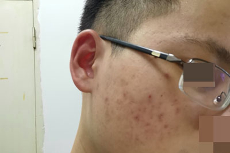 痤疮脸上有多个小坑图
