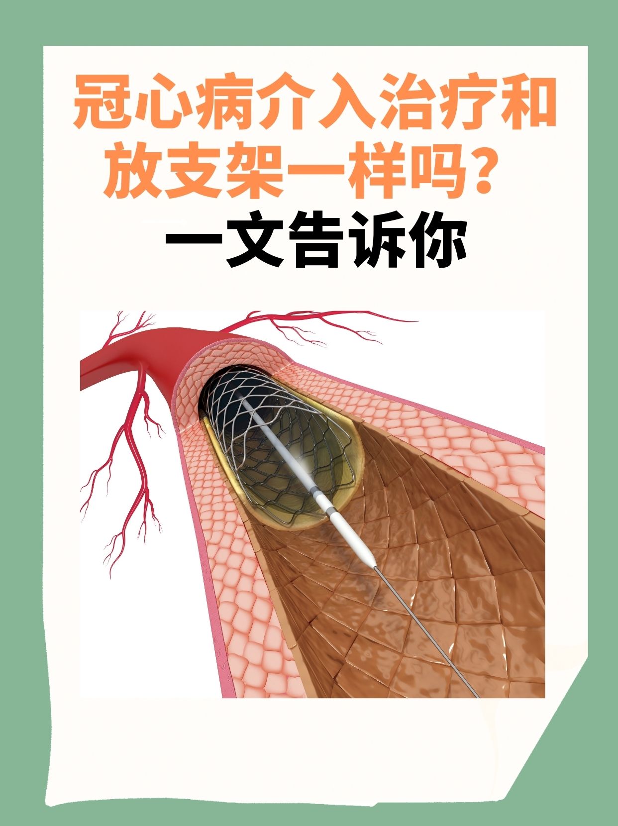 冠心病介入治疗和放支架一样吗?一文告诉你