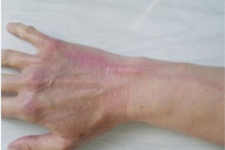 游走性血栓性静脉炎手背症状图