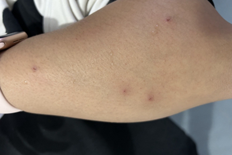 虫咬皮炎结痂图 虫咬皮炎结痂图