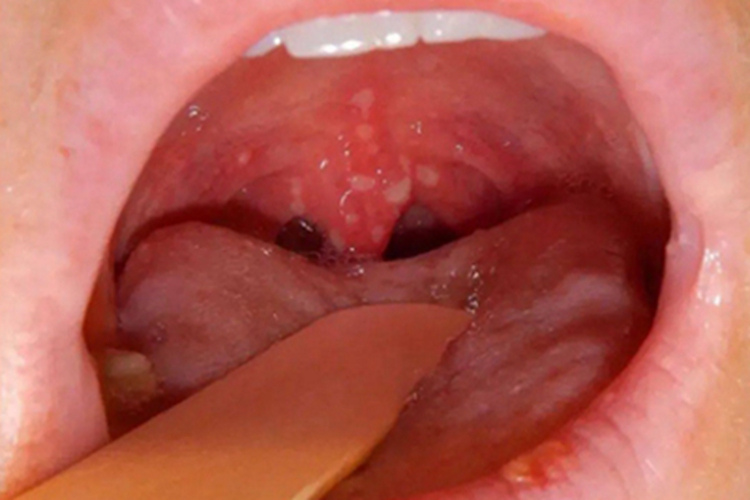 咽喉疱疹咽喉溃疡图 咽喉疱疹咽喉溃疡图