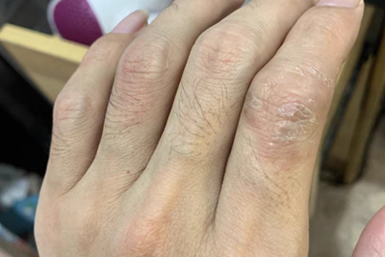 慢性湿疹手指结痂图 慢性湿疹手指结痂图