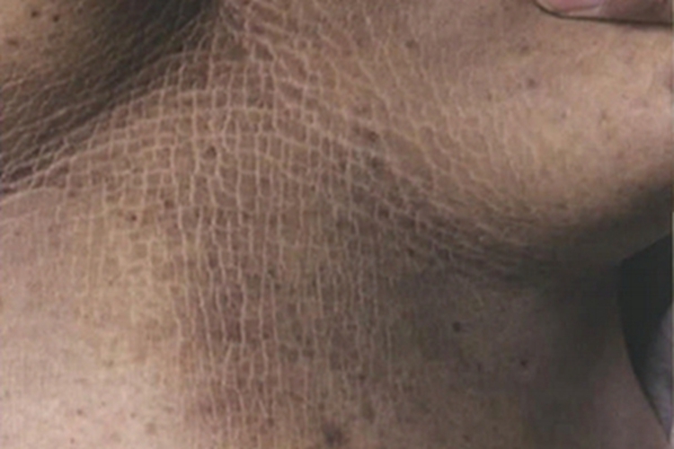 恶性黑棘皮病胸部长纹图