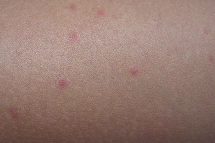 蚊叮咬后皮损图