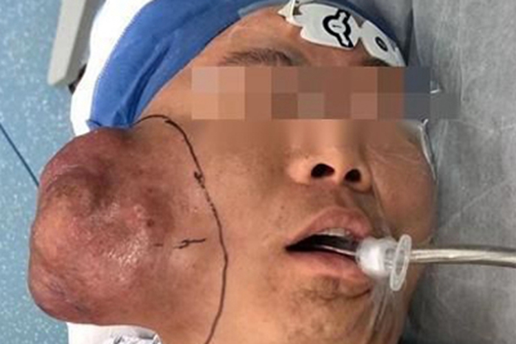 腮腺癌面部症状图