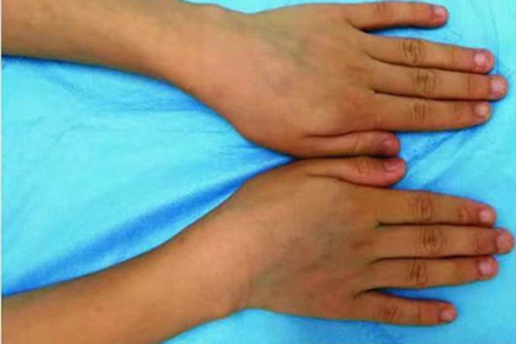 色汗症手背症状图