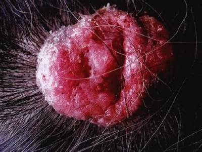粉瘤头皮图片
