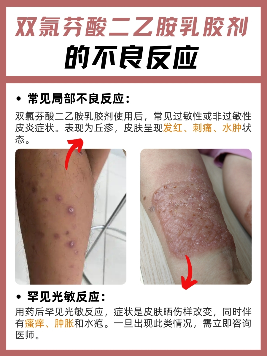 还不知？双氯芬酸二乙胺乳胶剂真面目大起底