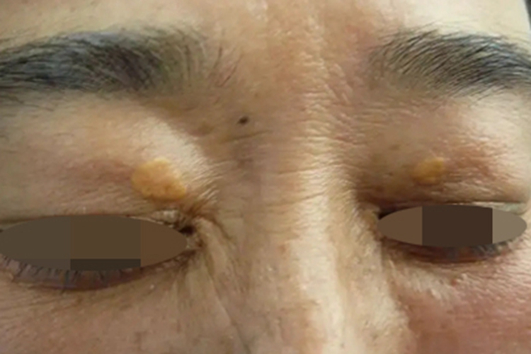 结节性黄瘤眼睑症状图