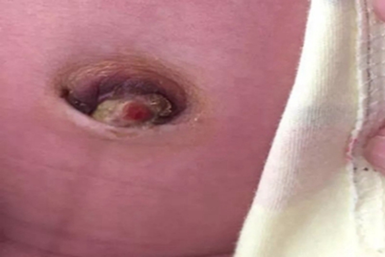 脐炎肚脐症状图 脐炎肚脐症状图