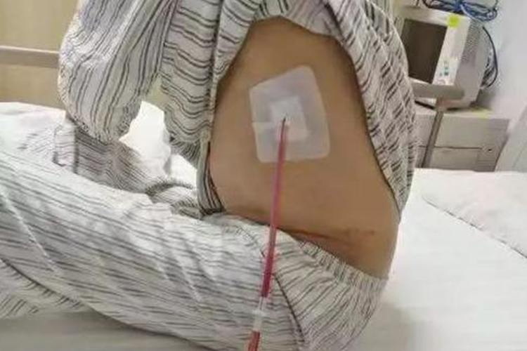 胸腔积液插管图