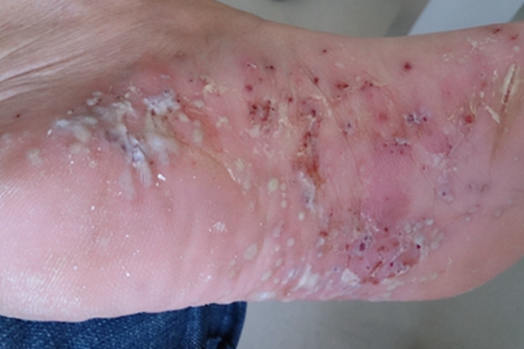 疱疹样脓疱病脚底脓包图