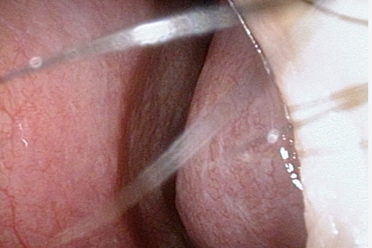 鼻甲肥大鼻甲肿胀图