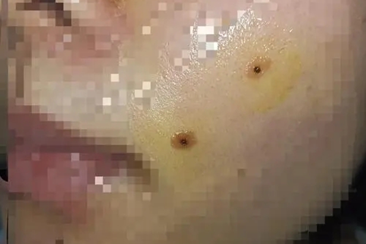 男士冷冻点痣图