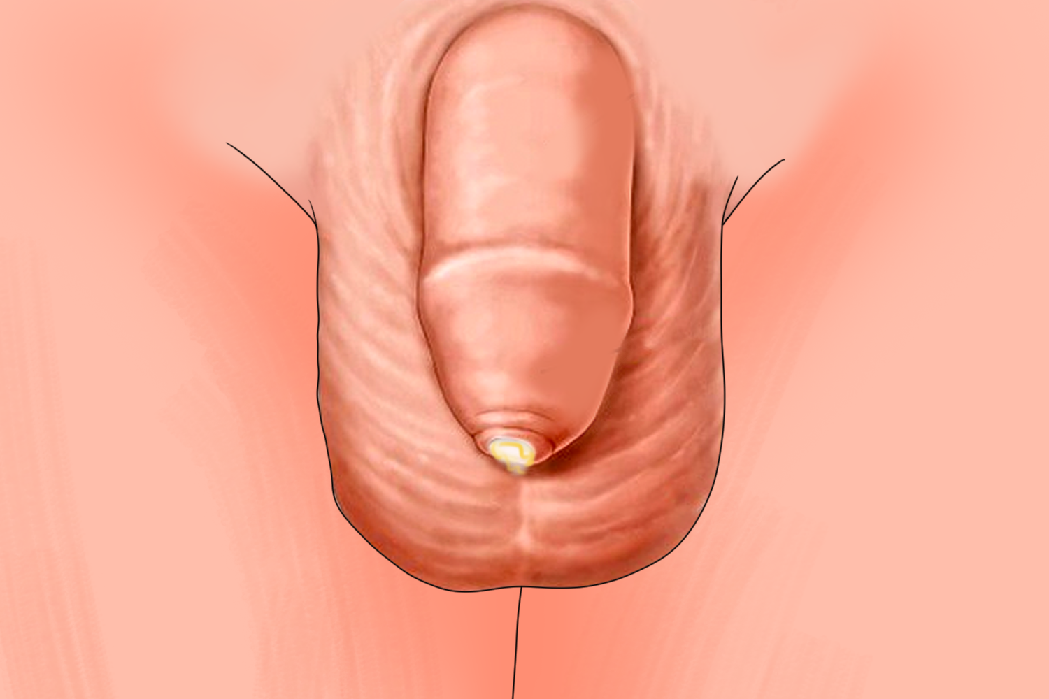 包茎导致龟头炎图