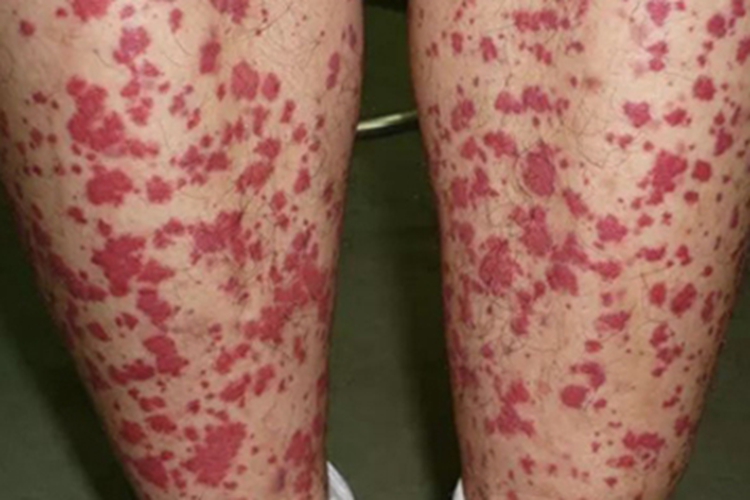 色素苔藓性紫癜样皮炎小腿症状图 色素苔藓性紫癜样皮炎小腿症状图