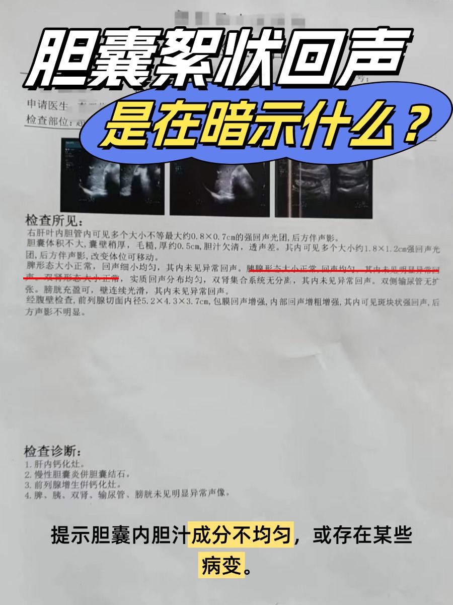 胆囊絮状回声，是在暗示什么？