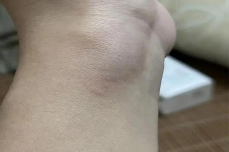 手腕皮脂腺囊肿图
